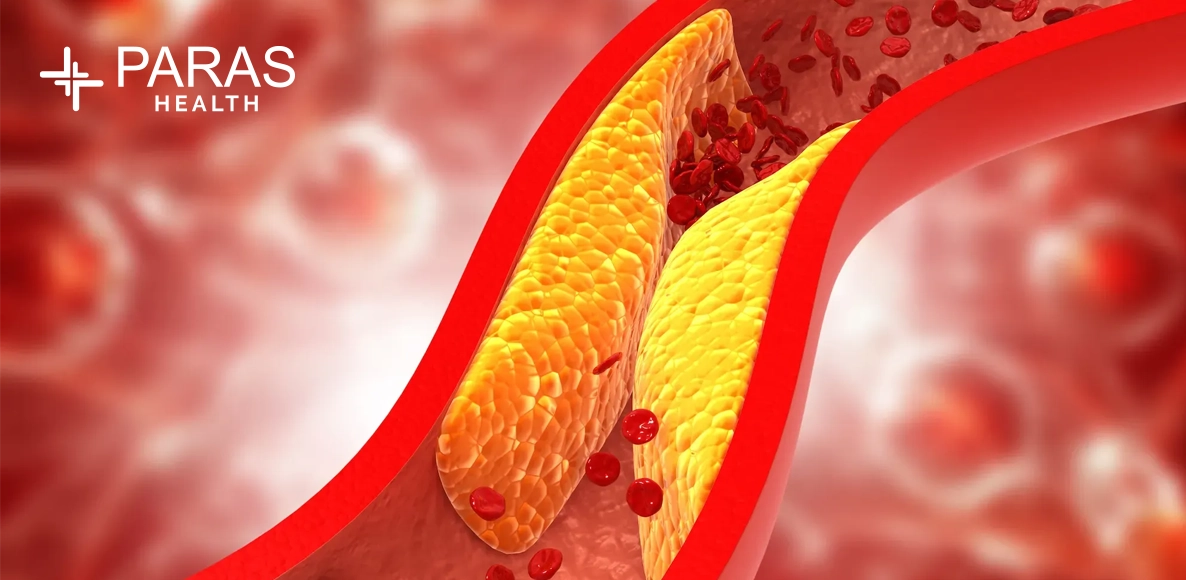 Everything You Need to Know About Symptoms of High Cholesterol